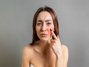 Ako sa prejavuje rosacea a čo sa s ňou dá robiť?